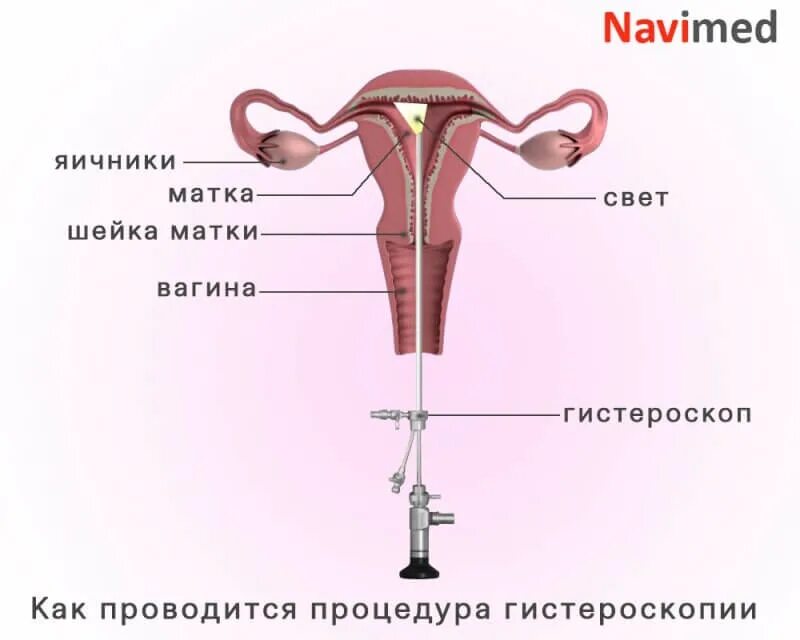 Гистероскопия матки что это такое как проходит. Гистероскопия инструменты. гистероскопия алгоритм манипуляции. здоровая матка гиистоскоп. схема проведения гистероскопии матки труб.