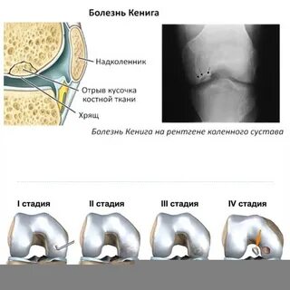 Рассекающий остеохондрит коленного сустава