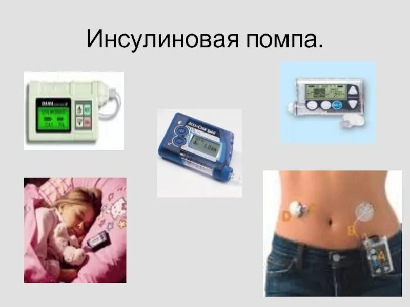 Инструкция инсулиновой помпы. Инсулиновая помпа 780g. инсулиновая помпа для диабетиков 1 типа. сахарный диабет 1 типа инсулиновые помпы. инсулиновая помпа на руку.