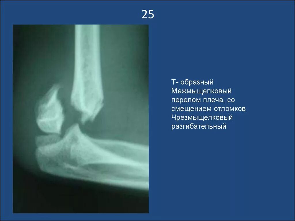 Чрезмыщелковый перелом со смещением. Чрезмыщелковый перелом плечевой кости остеосинтез. Перелом плечевой кости чрезмыщелковый плечевой. Перелом мыщелков плечевой кости. Чрезмыщелковый перелом со смещением.
