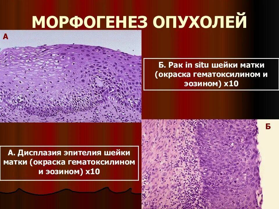 Дисплазия плоского эпителия. Карцинома шейки матки гистология. Дисплазия шейки матки гистология. Дисплазия шейки матки микропрепарат. Рак in situ шейки