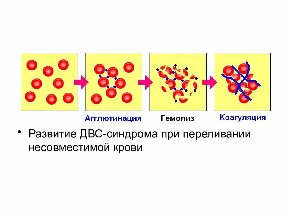 Гемолиз при переливании несовместимой крови. Агглютинация при переливании крови. Агглютинация и гемолиз. Агглютинация эритроцитов. Реакция агглютинации эритроцитов