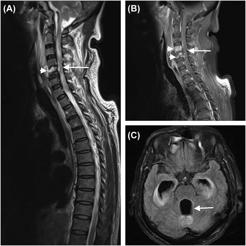 Spine mri. T2 mri. mri spine t1 vs t2. davf spine mri.