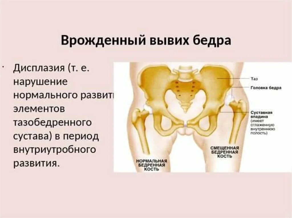 Физиологическая незрелость тазобедренных