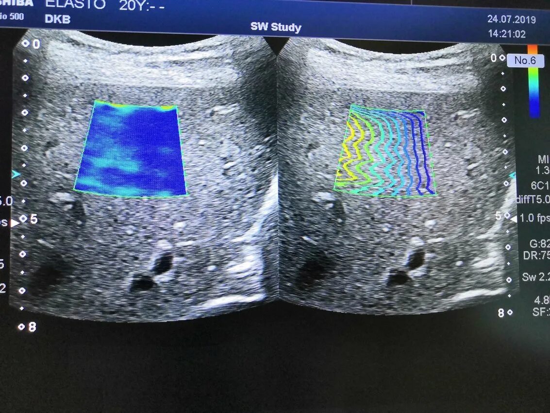 Ультразвуковая эластометрия печени. Фибросканирование (эластометрия печени). Цирроз печени эластография. Эластометрия печени УЗИ.