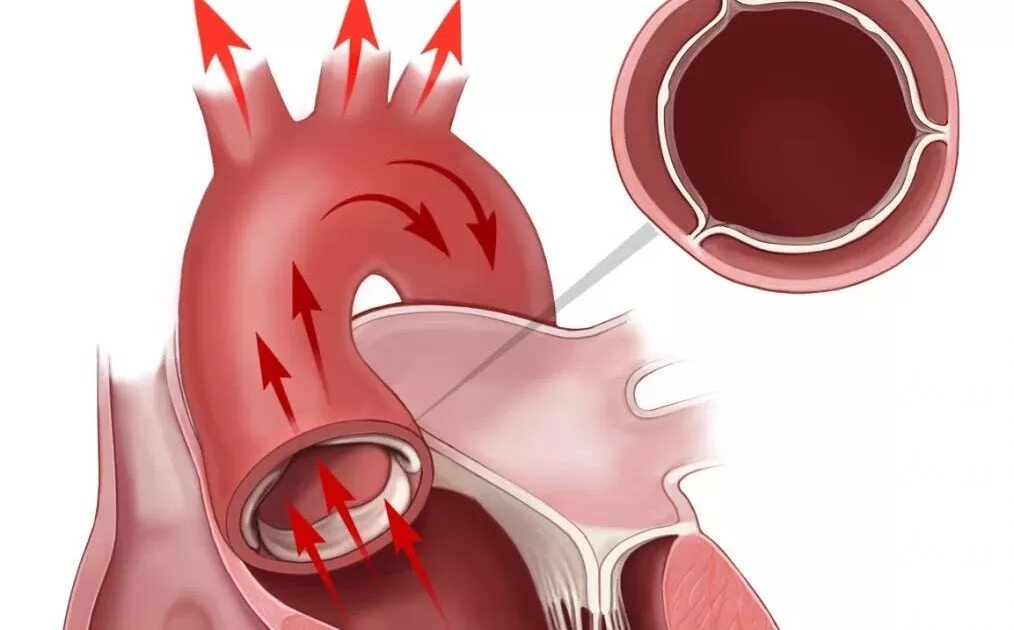 Кальциноз митрального клапана. Уплотнение стенок корня аорты и створок митрального клапана. Уплотнение корня аорты створок АК. Аорта уплотнена и аортальный клапан. Уплотнена створка аортальный клапан.