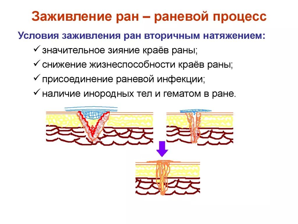 Этапы заживления ран. Этапы вторичного заживления РАН. Стадии заживления РАН вторичным натяжением. Заживление РАН хирургия вторичная натяжение. Фазы раневого процесса заживления РАН.