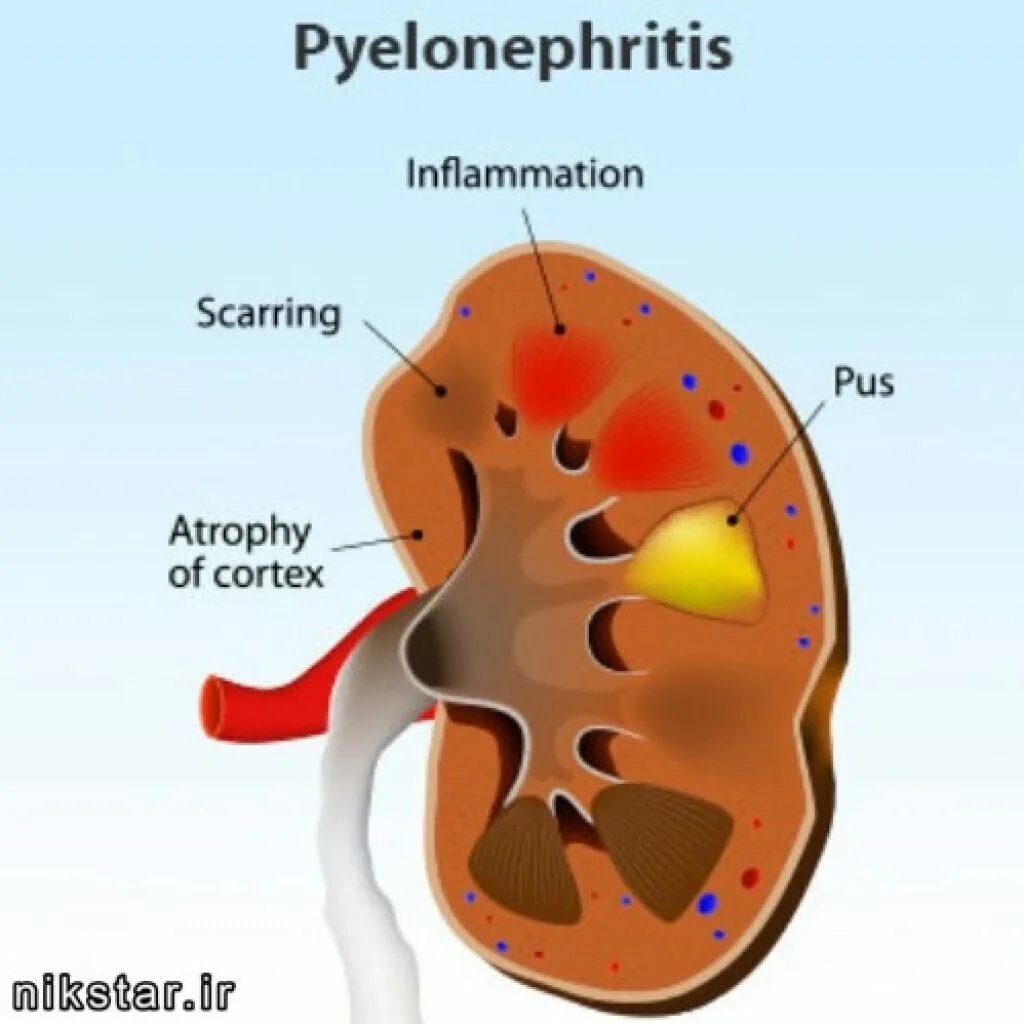 Пиелонефрит это воспаление. Воспалительный процесс в почках.
