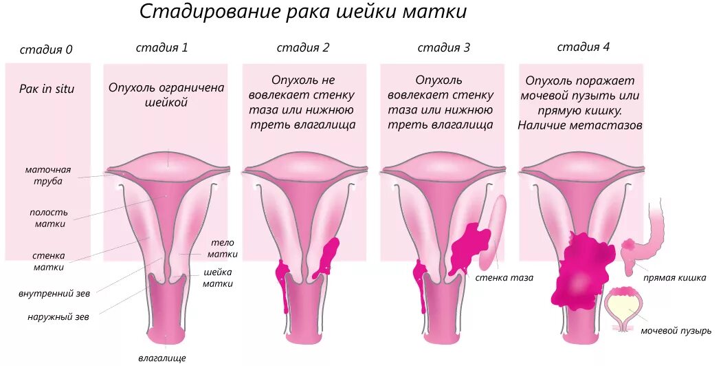 Как развивается рак матки. Онкология шейки матки 4 стадия симптомы. Степени онкологии шейки матки. Опухоль шейки матки 1 стадия. Стадии развития опухоли шейки матки.