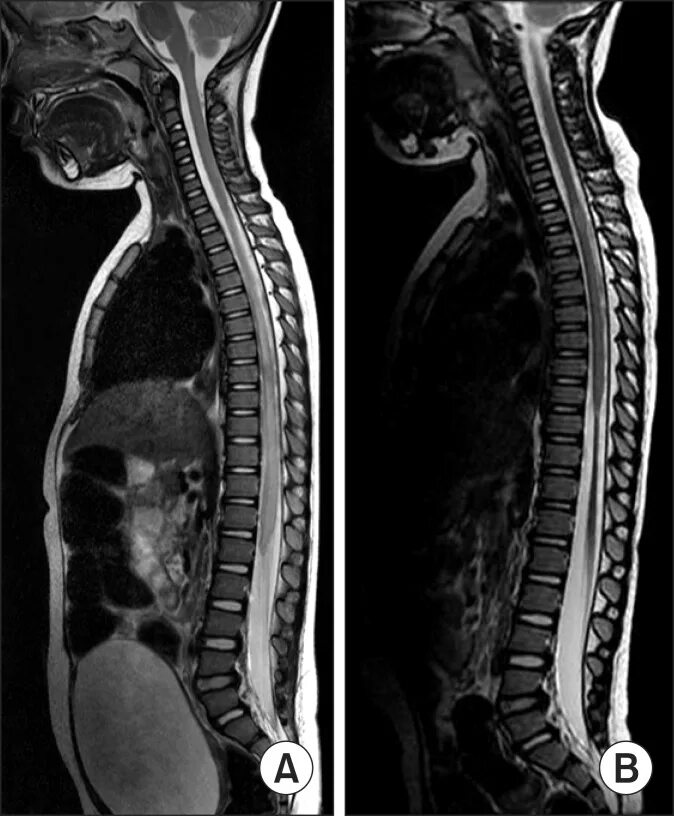 Spine mri. Поперечный миелит мрт. mri spine t1 t2. миелит грудного отдела мрт. миелит неврология.
