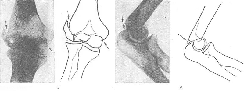 Мыщелковый перелом локтевого сустава. Надмыщелковый перелом плечевой кости. Чрезмыщелковый перелом плечевой кости. Перелом мыщелков плечевой кости.