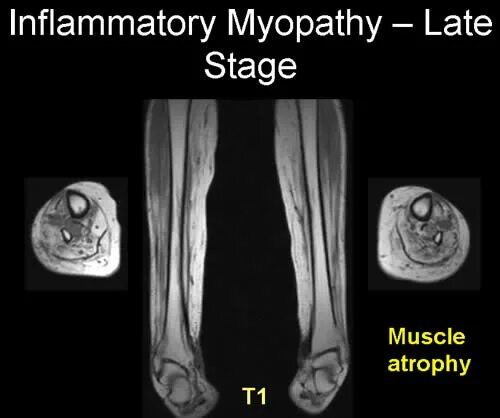 Стероидная миопатия. Миофибриллярная миопатия. Воспалительные миопатии.