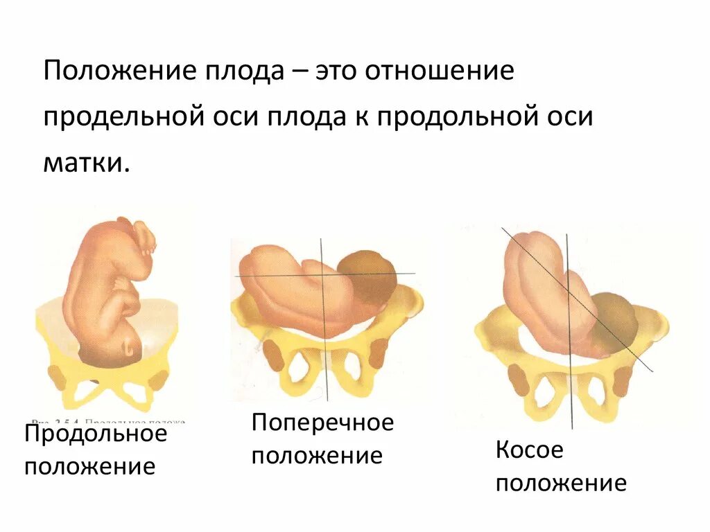 Предлежание плода 2. Продольное поперечное косое положение плода. Продольное переднее положение плода. Предлежание тазовое, положение продольное 2 позиция плода. Продольная ось плода и матки.