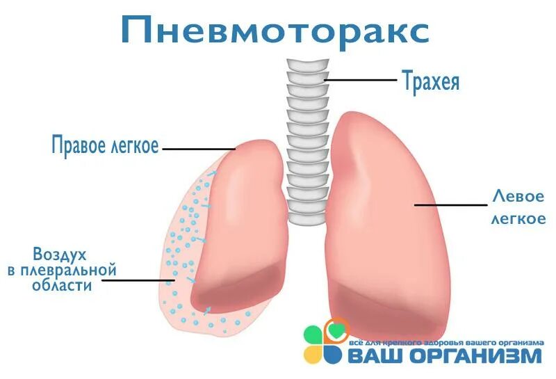 Закончился воздух в легких