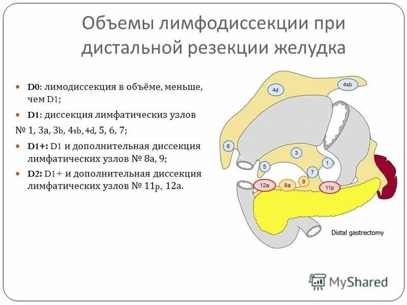 Лимфодиссекция при раке. Лимфоузлы желудка d3 диссекция. Уровни лимфодиссекции. Лимфодиссекция д2 при гемиколэктомии. Гастрэктомия с лимфодиссекцией d2.