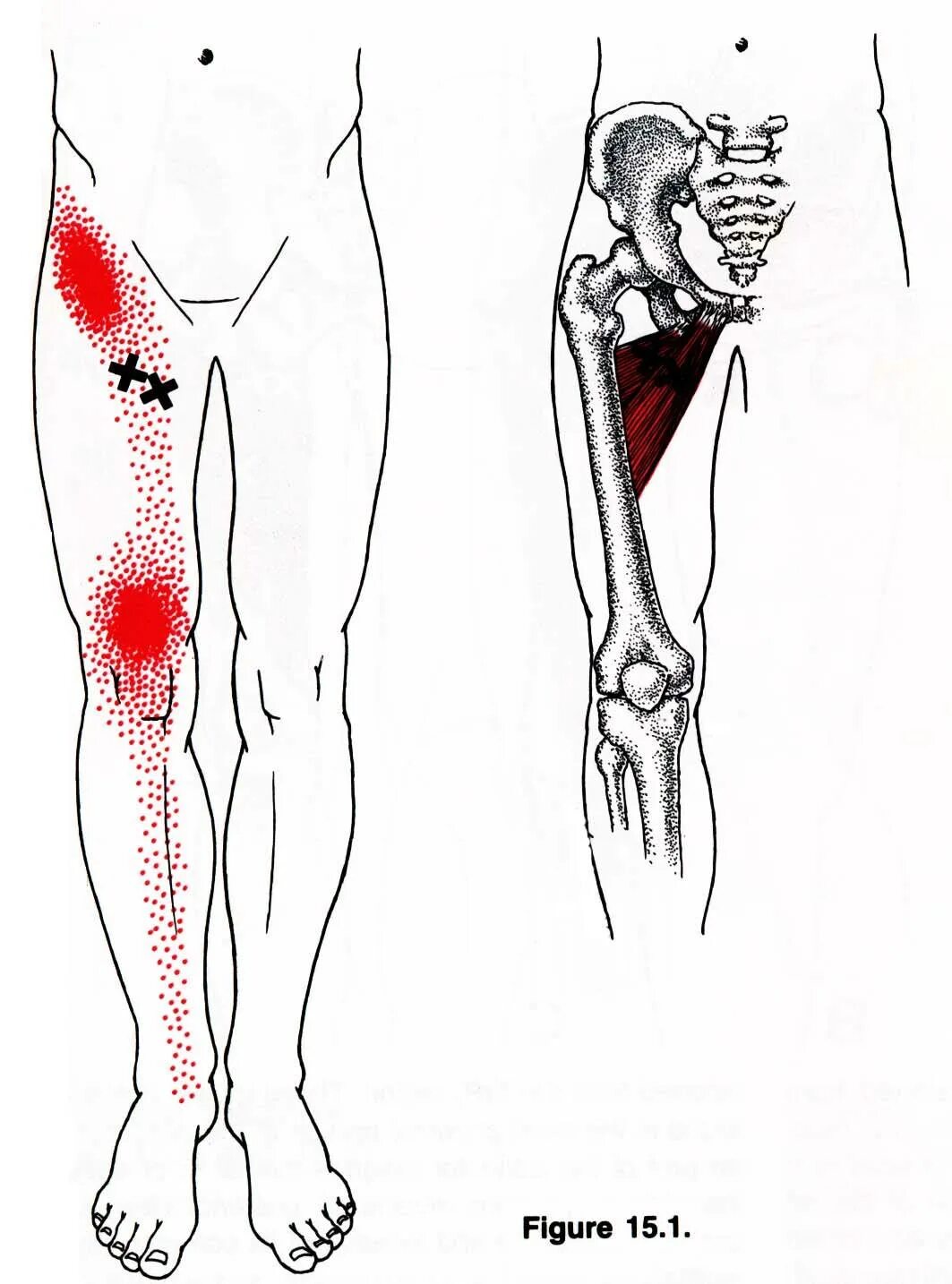 Сильная боль в бедре. Триггерные точки бедра. Триггерные точки тазобедренного сустава и бедра. Триггерные точки бедра триггерные.