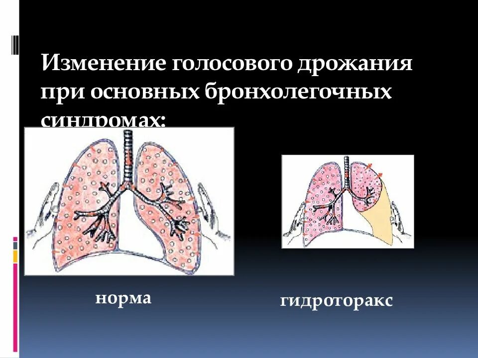 Усиленное голосовое дрожание. Гидроторакс голосовое дрожание. Голосовое дрожание при гидротораксе. Изменение голосового дрожания.