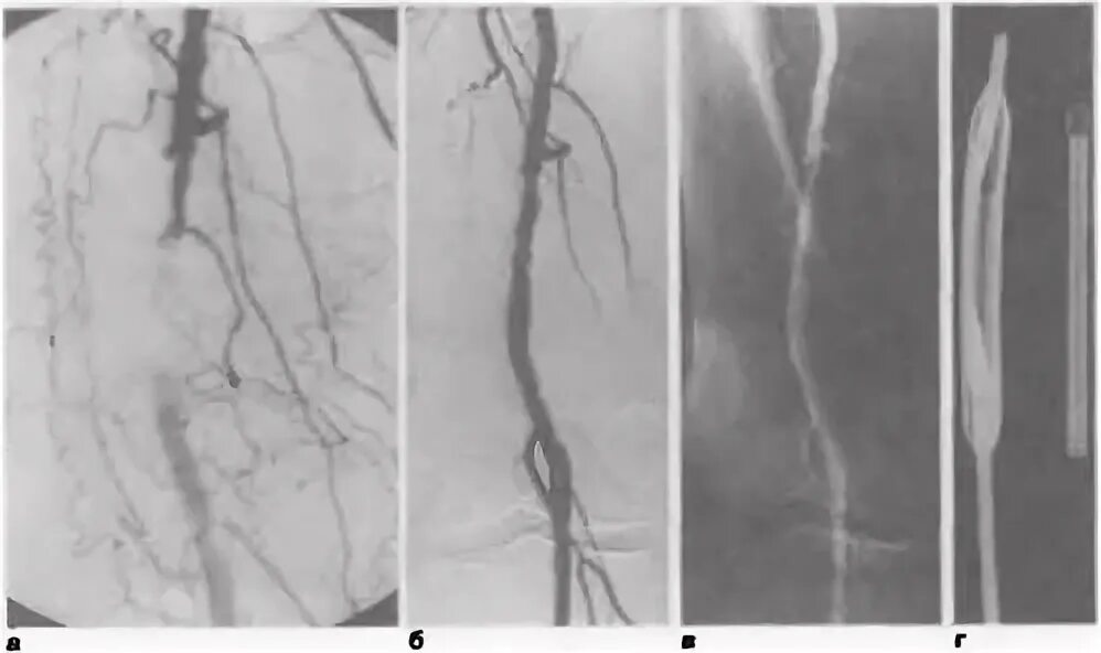 Баллонная ангиопластика нижних конечностей