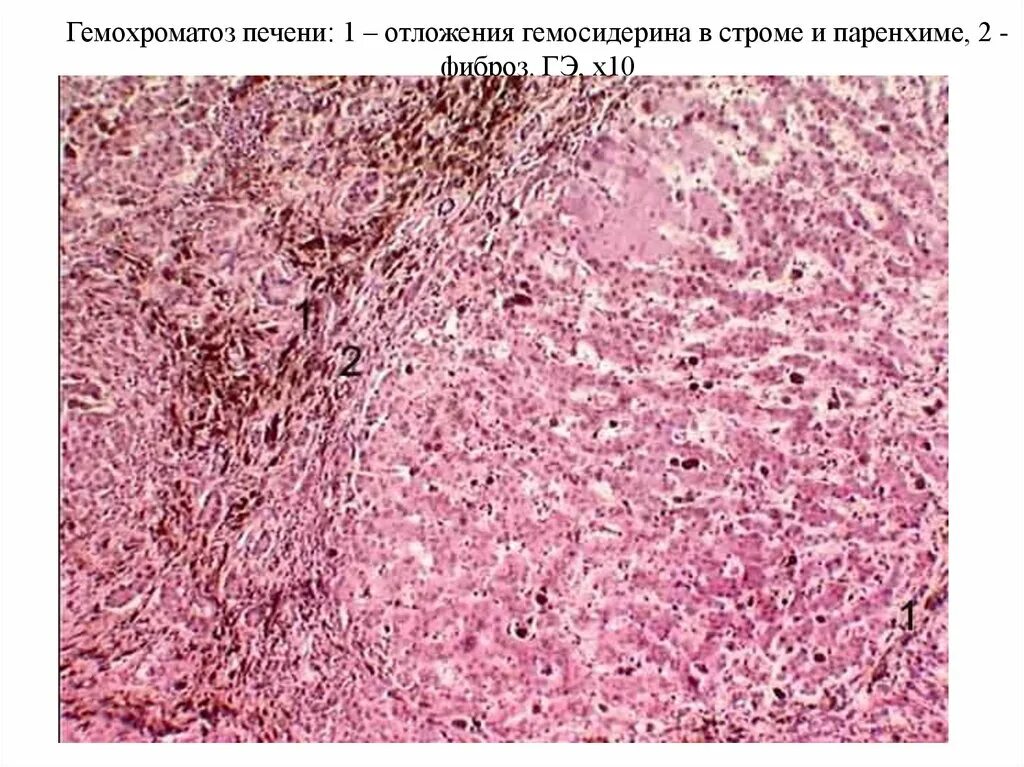 Фиброзные изменения печени. Гемосидероз селезенки микропрепарат. Гемохроматоз печени патологическая анатомия. Гемосидероз селезенки микропрепарат патанатомия. Гемохроматоз селезенки гистология.