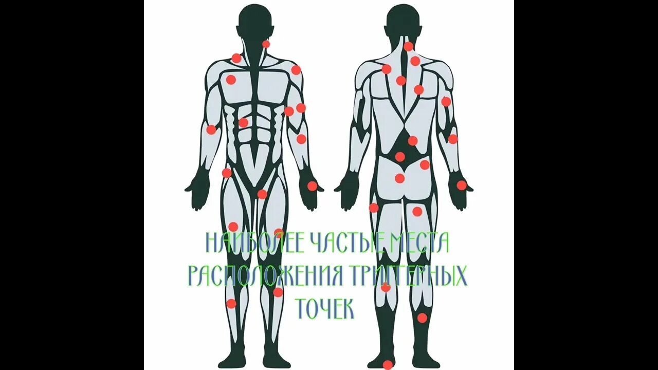 Схема боли в спине. Карта триггерных точек спины с отраженными болями. Миофасциальные болевые триггерные точки тела человека. Карта триггерных точек на теле человека. Фибромиалгия триггерные точки.
