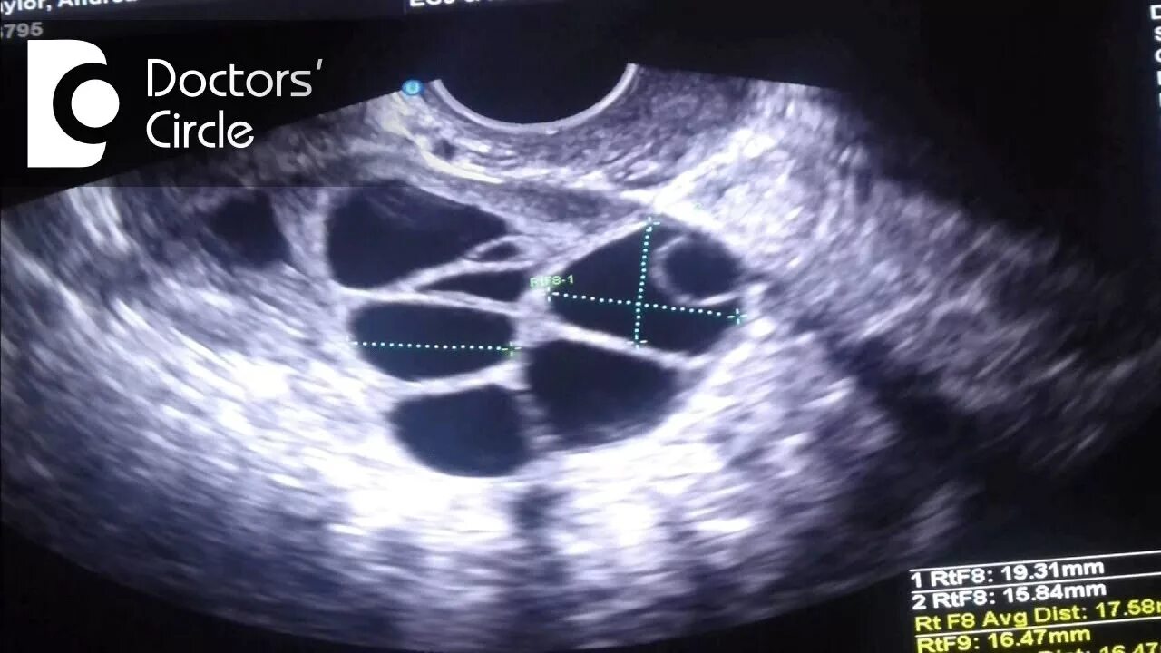 Стимуляция суперовуляции схемы. Ультразвуковой мониторинг овуляции. Узи после пункции фолликулов. Трансвагинальная пункция фолликулов. Фолликулы стимуляции эко.