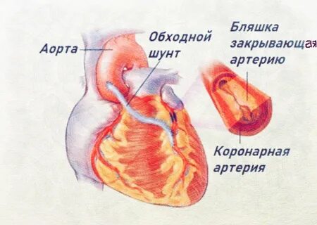 Операция коронарный сосуд