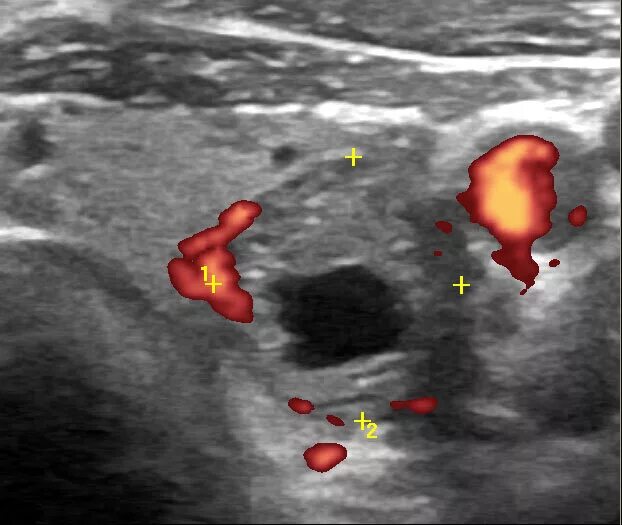 Узел в левой доле щитовидной. Анэхогенный узел щитовидной железы. Доброкачественные узлы щитовидной железы на УЗИ. Кистозный узел щитовидной железы. Щитовидная железа УЗИ норма и узлы.