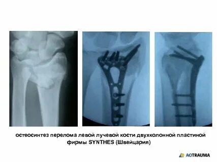 Рука операция лучевой