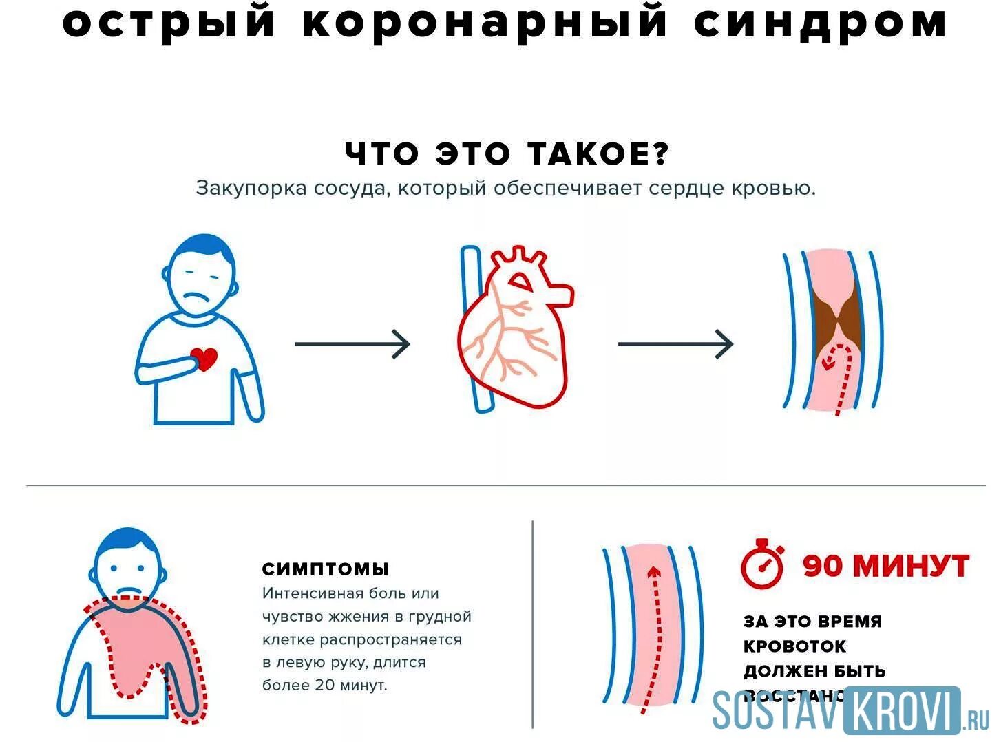 Синдром острой коронарной недостаточности симптомы. Острый коронарный синдром симптомы. Симптомы остром коронарном синдроме. Острого коронарного синдрома (Окс) неотложная помощь. Синдром что это такое простым языком