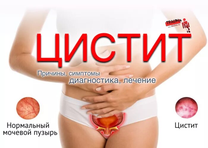 Цистит симптомы причины. Цистит у женщин.