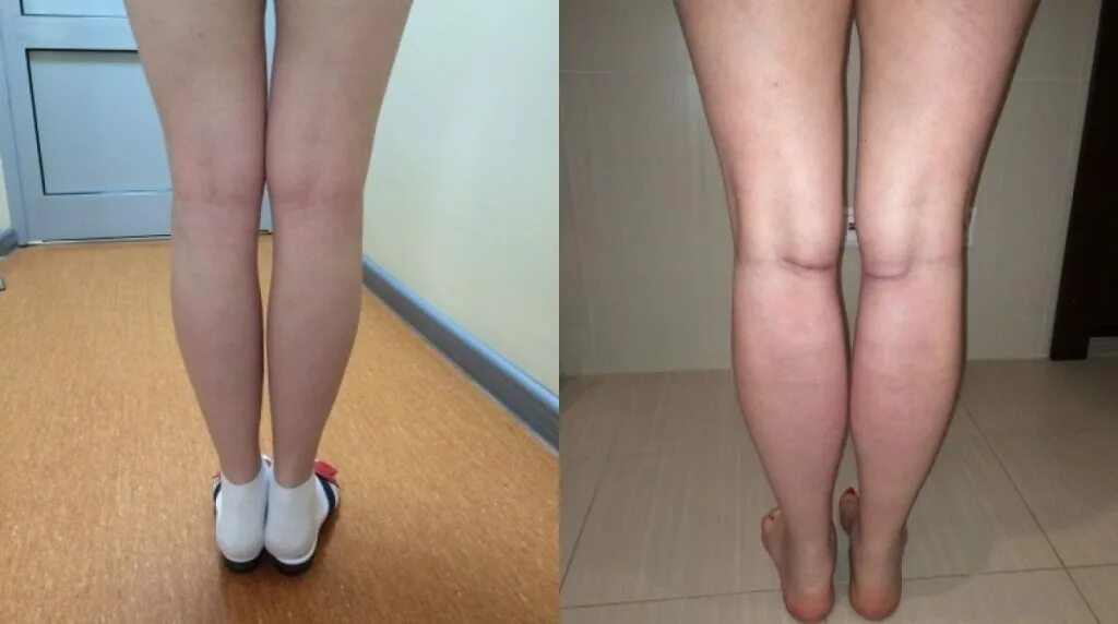 асимметрия ножек. атрофия икроножных мышц. эндопротезирование голеней. круропластика голени асимметрия голени. адипозогенитальная дистрофия.