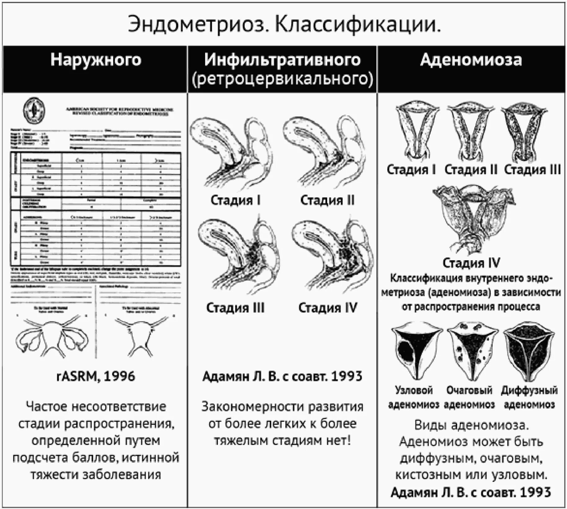 Что такое признаки внутреннего эндометриоза матки. Ретроцервикальный эндометриоз классификация. классификация эндометриоза ретроцервикальной локализации. наружный генитальный эндометриоз классификация. enzian классификация эндометриоз.