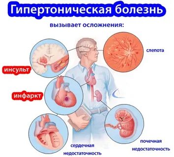 Почечный инсульт