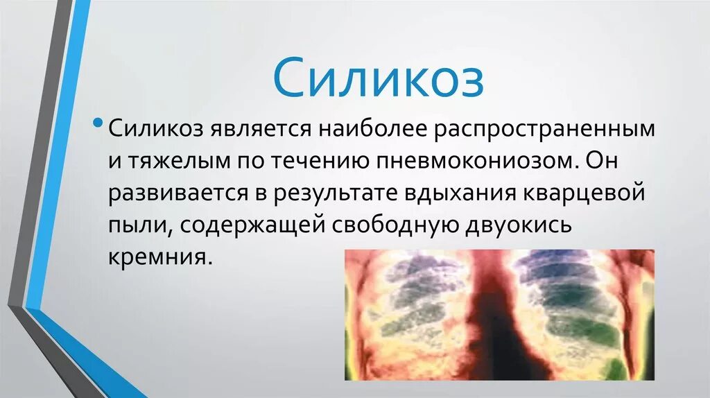 Силикоз это. Силикотоз легких рентген. Силикоз — это заболевание, обусловленное вдыханием пыли, содержащей. Силикоз это. Силикоз-антракоз легкого.