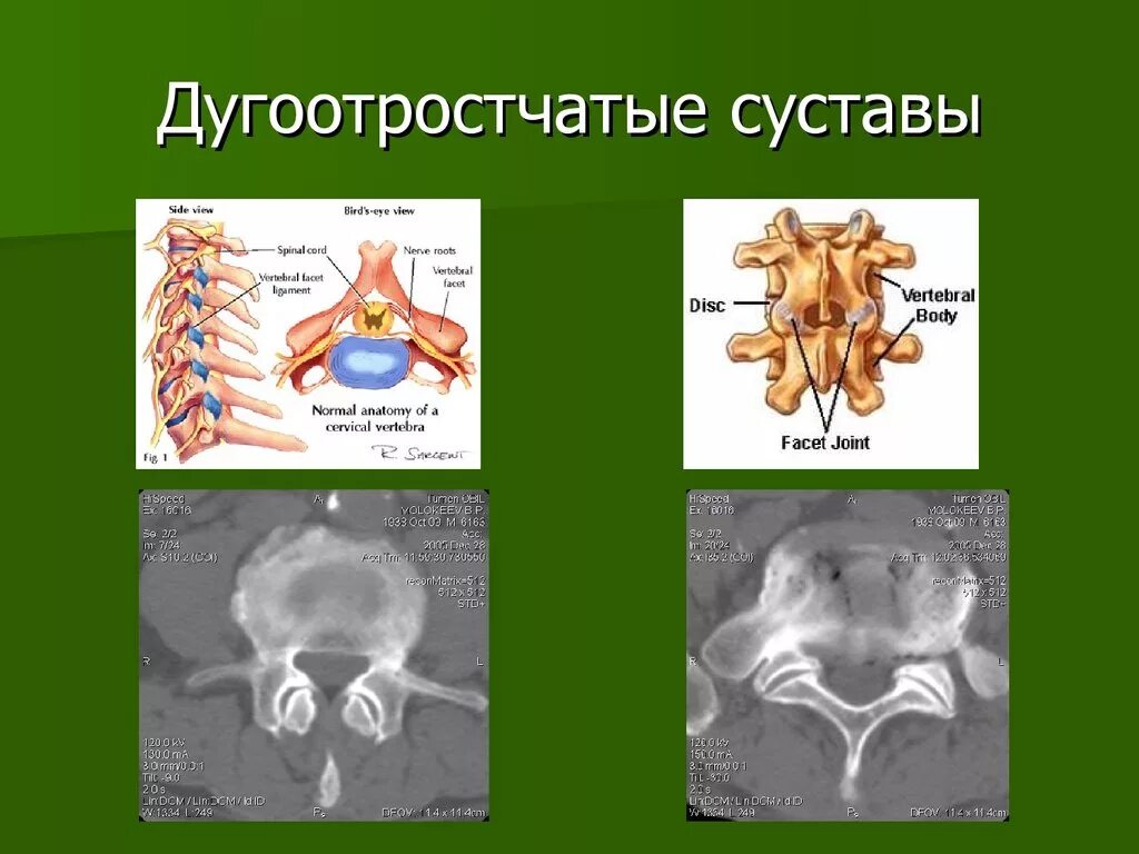 Фасеточный сустав анатомия. Дугоотростчатый сустав форма. Дугоотросчатые суставы позвонков. Межпозвоночные суставы характеристика. Дугоотросчатые суставы связки.