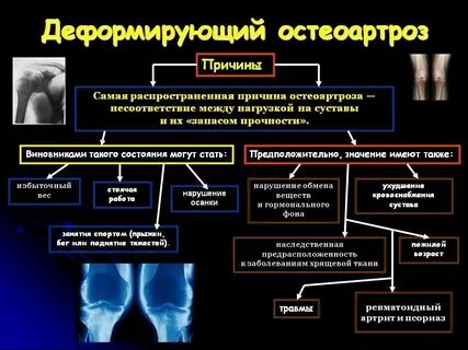 Степени болезни артроза