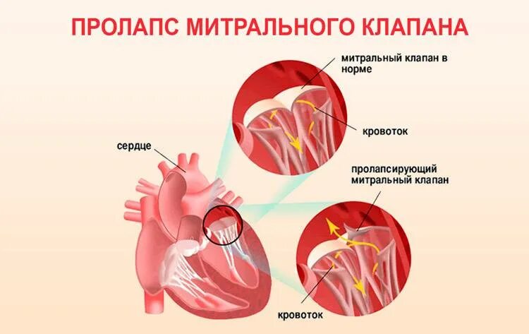 Дегенерация митрального клапана. Параллакс митрального клапана 1 степени. Симптомы пролапса митрального клапана 1. Пролапс митрального клапана 1 степени симптомы у подростков. Что такое пролапс митрального клапана сердца 1 степени.