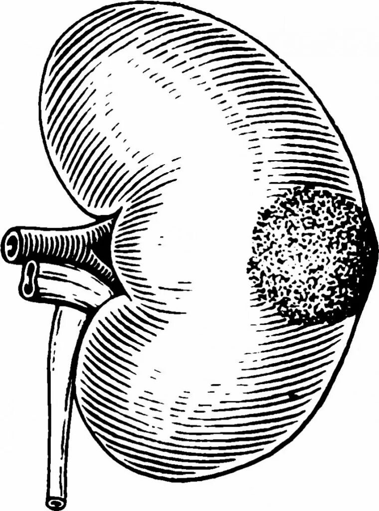 Почка округлой формы. Нефрит карбункул почки.