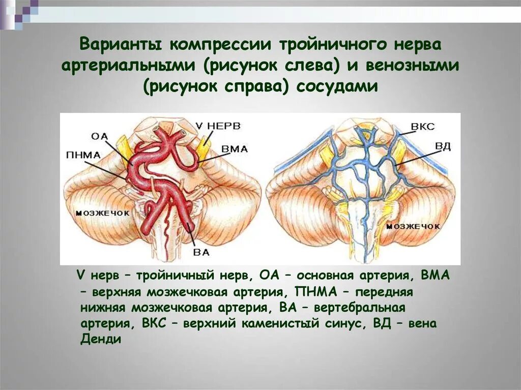 Нейроваскулярный конфликт тройничного нерва. Компрессия тройничного нерва артериальным сосудом. Тройничный нерв и мозжечковая артерия. Конфликт тройничного нерва и артерии.