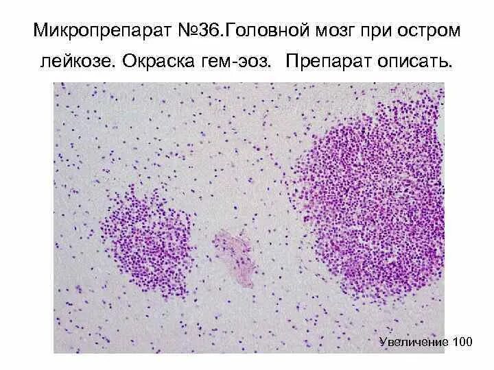 Микропрепарат головного мозга. Мозг при остром лейкозе микро. Острый лейкоз гистология. Костный мозг при остром лейкозе макропрепарат. Мозг при остром лейкозе микропрепарат.