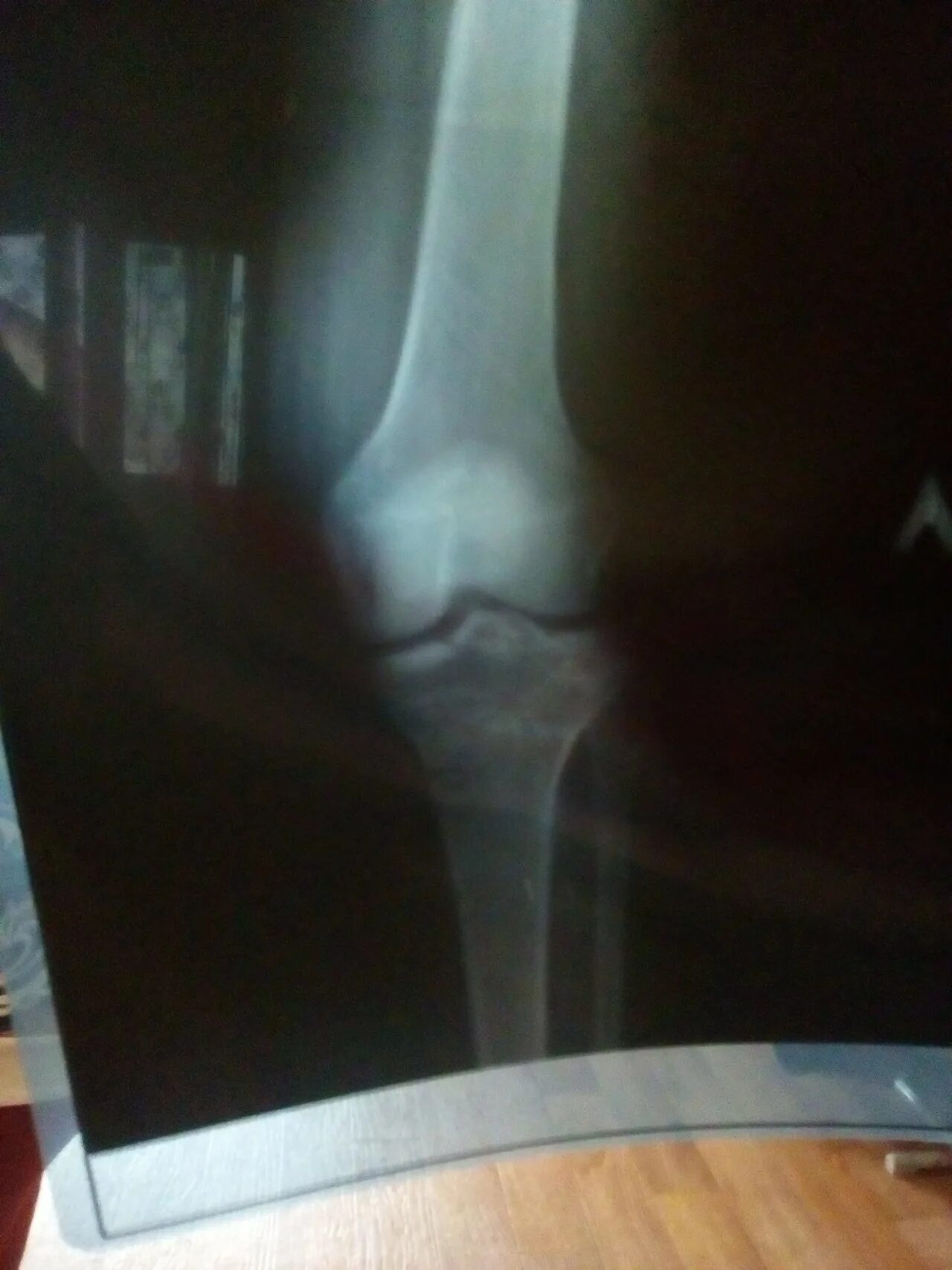 Перелом чашечки коленного сустава рентген. Перелом коленного сустава рентген. Перелом коленной чашечки рентген. Ушиб коленной чашечки рентген.
