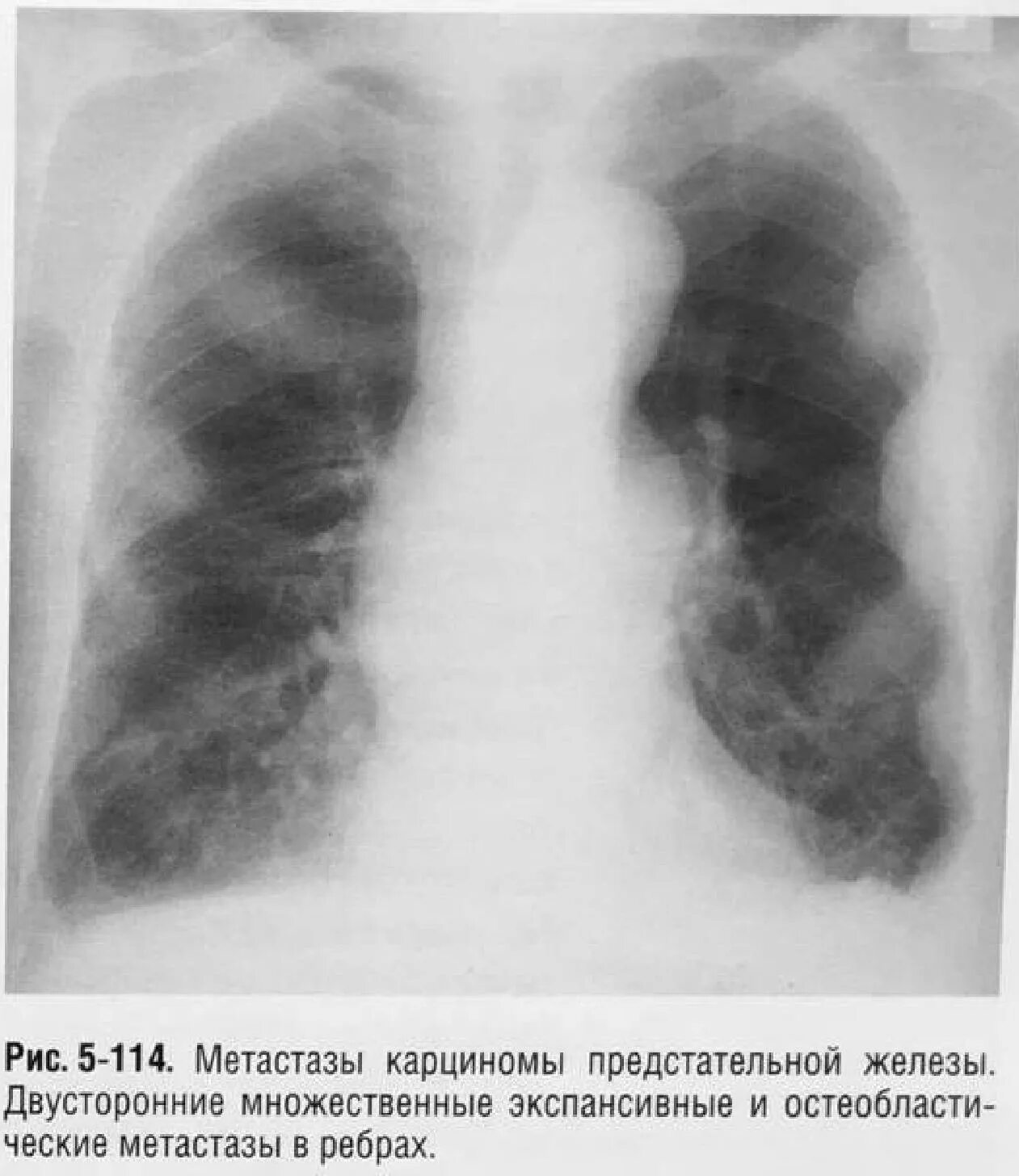Метастазы в костях при раке легких. Метастазы в костях при раке легких