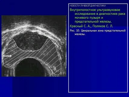 Центральная зона предстательной железы