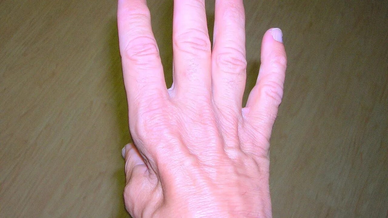 Синдром зудека лечение. Атрофофия мышц кисти рук.