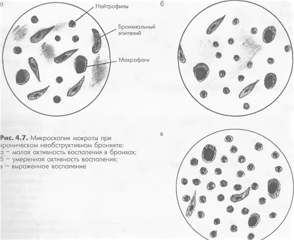 В мокроте можно обнаружить. Мокрота нативный препарат микроскопия. Микроскопия мокроты атлас. Микроскопия мокроты расшифровка.