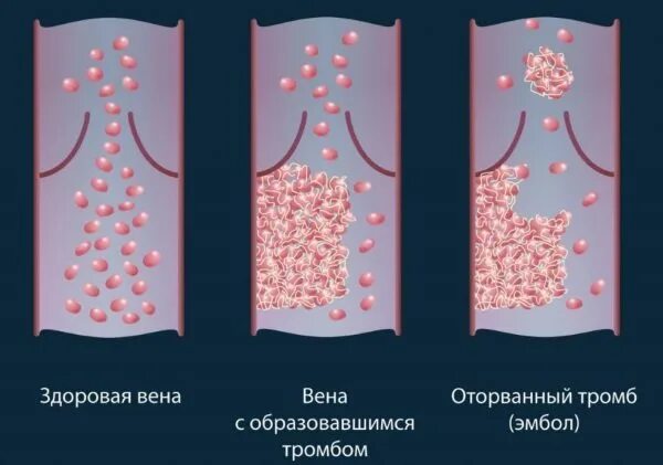 Что делать если обнаружили тромб. Что делать если обнаружили тромб