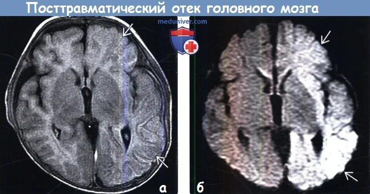 Оттек головного мозга