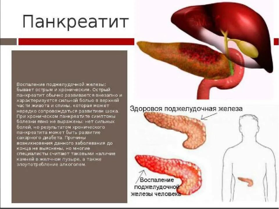 Можно ли вылечить панкреатит. Панкреатит заболевание поджелудочной железы симптомы. болезнь панкреатит и панкреатин. панкреатит симптомы панкреатин. панкреатит заболевание пищеварительной системы.