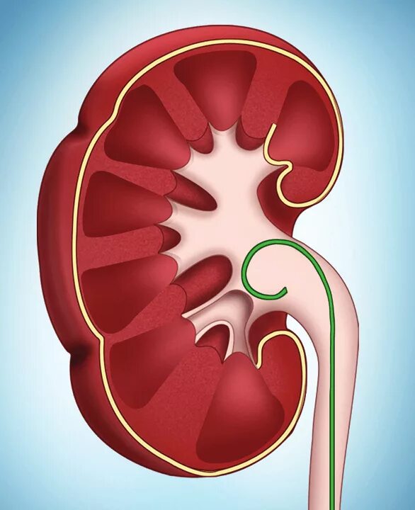 Стент в мочеточнике у женщин. Стент мочеточниковый в почке. Стентирование левого мочеточника. Стент мочеточниковый вс почке.