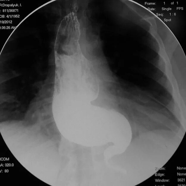 Кардия не смыкается что это значит. Ахалазия кардии рентген. Ахалазия желудка рентген. Ахалазия кардии на рентгенограмме. Кардиал ахалазия пищевода.